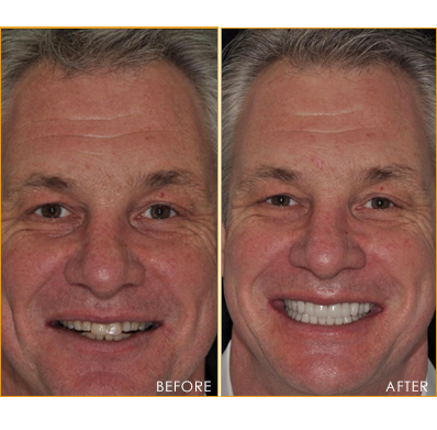 Full Mouth Reconstruction