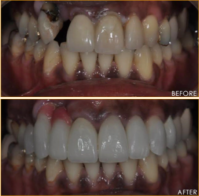 Dental Implants