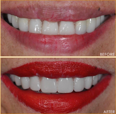 Dental Implants New York