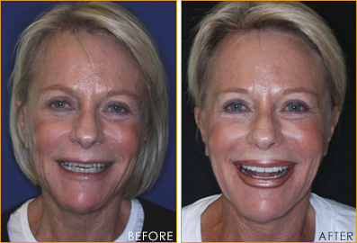 smile makeover NY