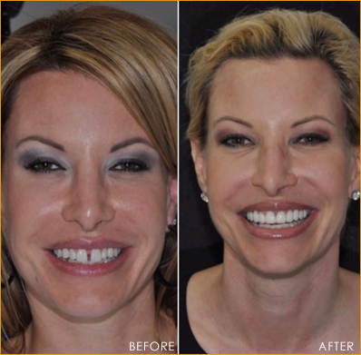 Veneers